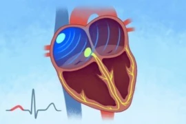 Slow and unsteady - Understanding bradyarrhythmias